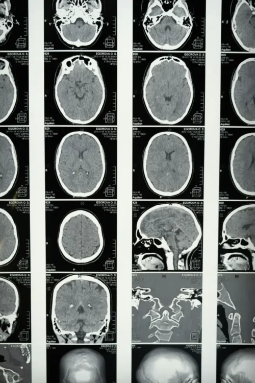 MRI dla zdrowia, czyli badanie rezonansem magnetycznym